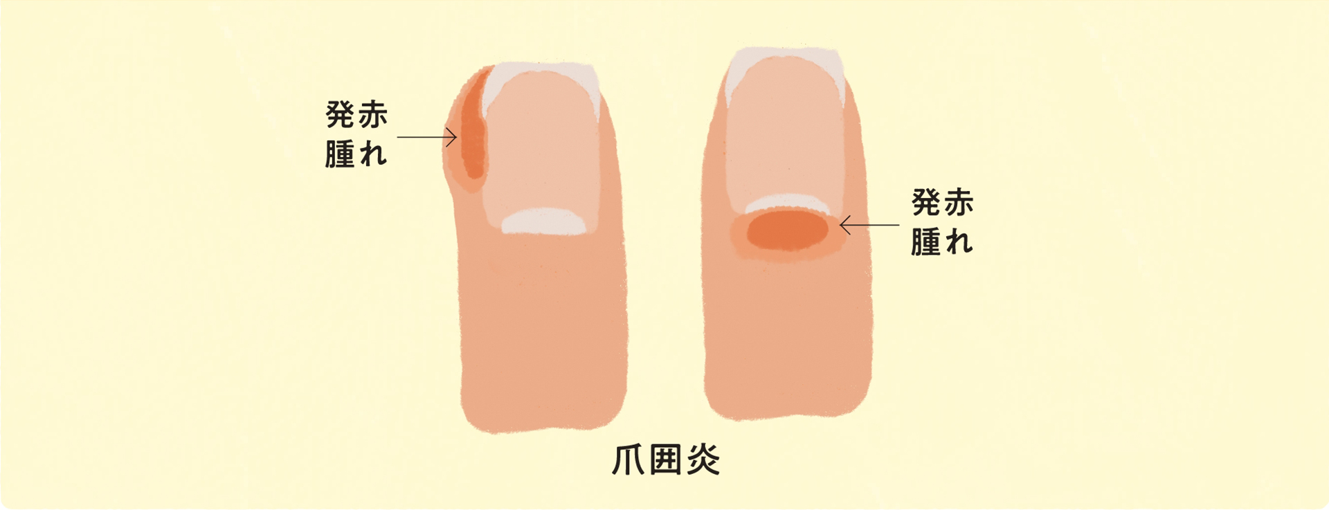 重度の皮膚障害 爪囲炎