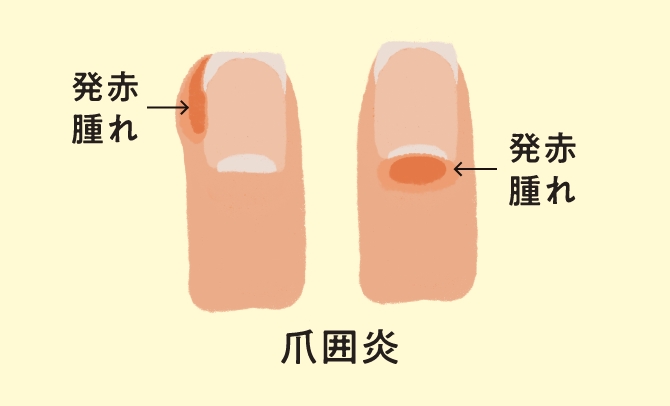 重度の皮膚障害 爪囲炎